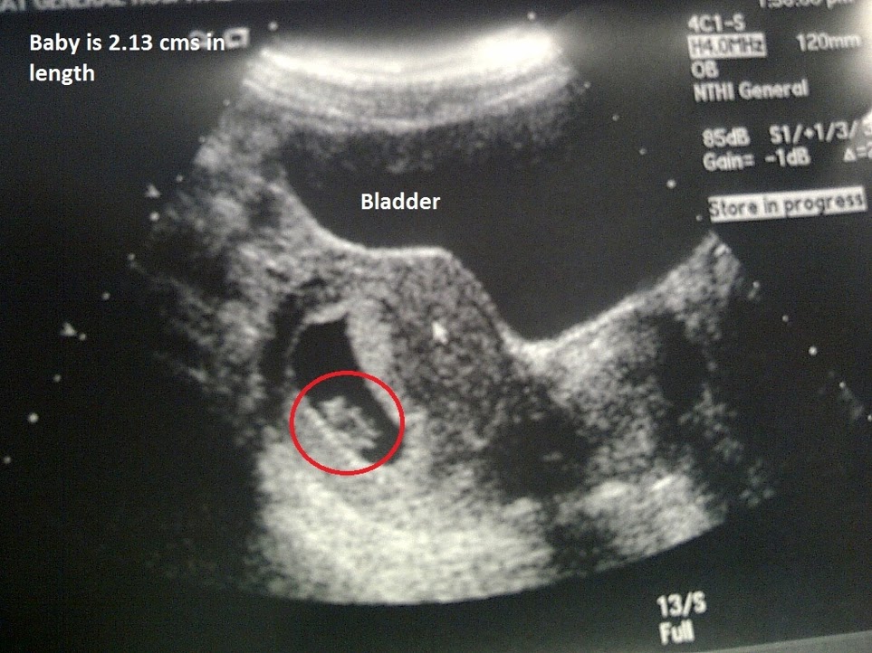 how accurate is a 8 week dating scan